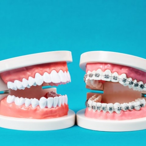 歯列矯正とセラミック矯正の違いは？特徴を徹底解説サムネイル