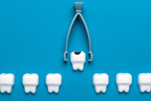 抜歯矯正とはどんな治療？抜歯矯正のメリットとデメリットサムネイル